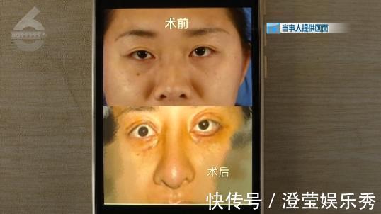 右眼|比原来丑这么多!女子花钱整成“阿凡达”眼睛都闭不上:“昨晚又是一夜没睡”