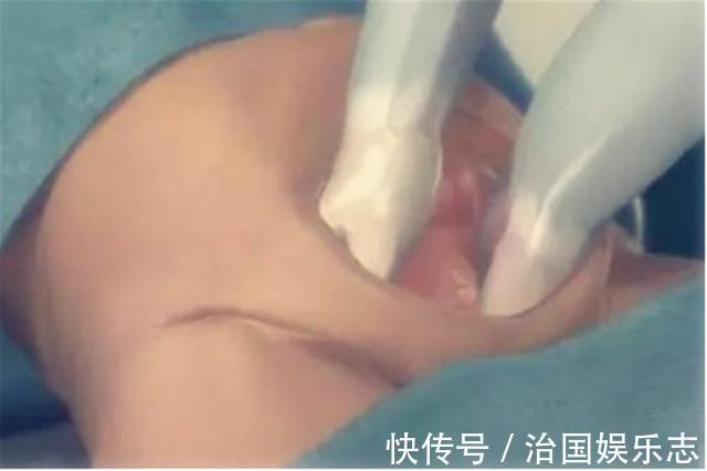 宝妈|九张剖腹产手术全过程图片,那些说生孩子容易的人好好看看