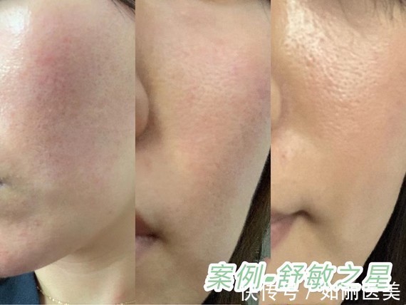 医美 你是敏感肌吗？敏感肌适合做什么医美项目？ 如何做好日常护理？