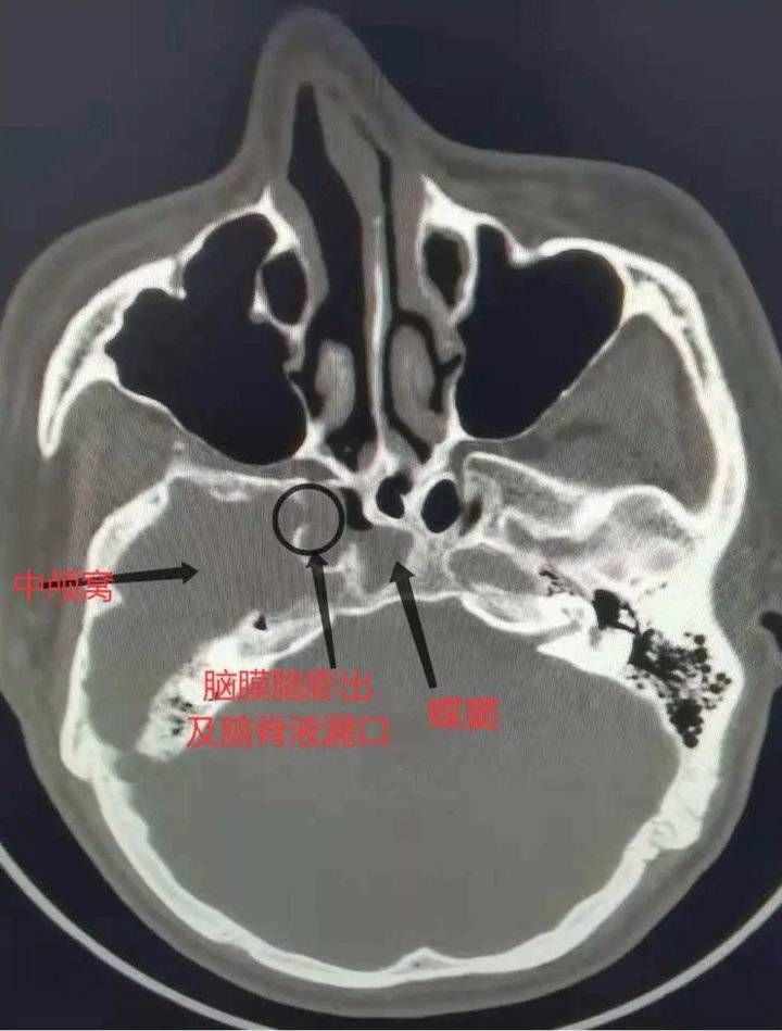 鼻内镜|流“鼻涕”一个多月,竟是脑脊液!鼻内镜下脑脊液修补术解难题