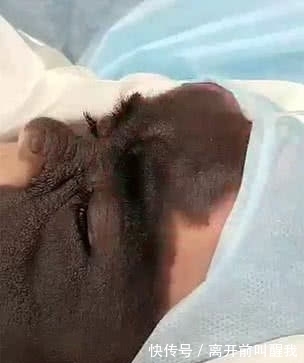 面具|7个月婴儿脸上因巨大黑色胎记爆红!像带着“蝙蝠侠”面具!