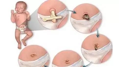 脓性|肚脐眼竟然藏着“生老病死”的秘密!现在知道还不晚,建议收藏!