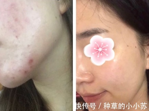 起泡网|“战痘多年”还是失败?99%的“痘友”不知道这些战痘洗面奶