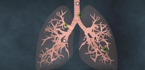 就诊|肺癌早期也是有迹可循的，身体出现这5个异常，还请及时就诊检查！
