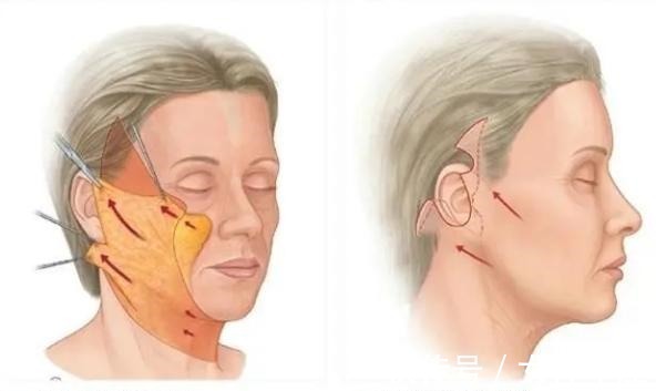 面部 46岁做拉皮手术是种什么体验，分享一下我的真实经历！