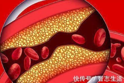 血管内皮|甘油三酯高的人,就会长颈动脉斑块吗?为何有人不高也会长斑块?