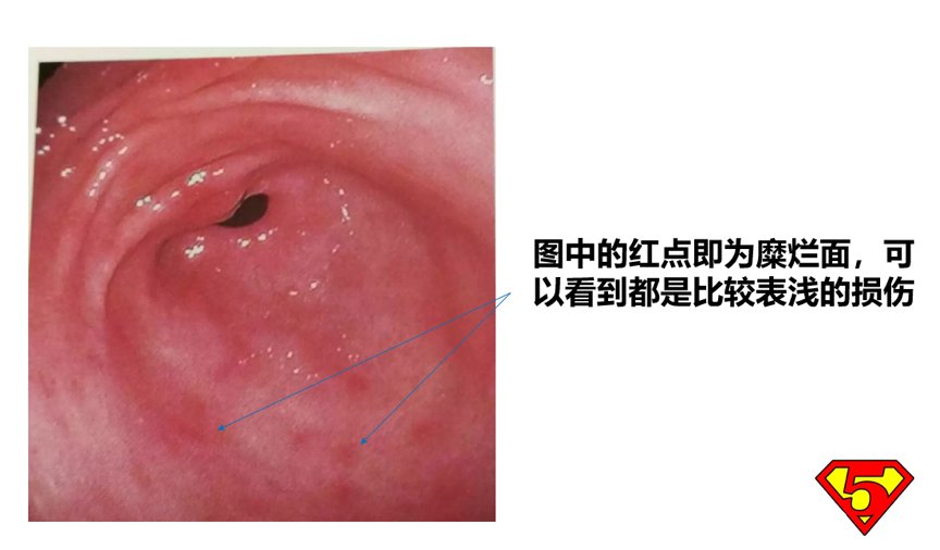 饮食习惯|糜烂性胃炎严重吗？医生：如不注意会引发胃溃疡，造成更严重后果