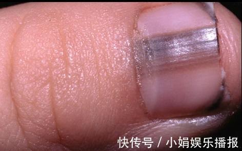 黄甲综合征|身体有问题,指甲告诉你!指甲出现9种变化,恐是疾病来袭