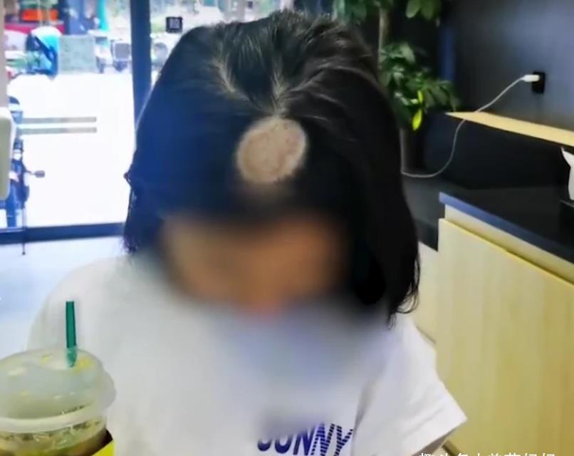 小女孩|6岁女孩突然“秃头”,奶奶以为是鬼剃头,医生怒斥无知