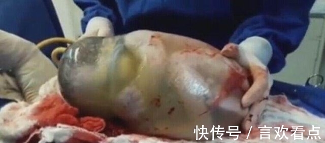羊膜囊|巴西女子生下“魔力宝宝”,在场所有医生都惊呆了