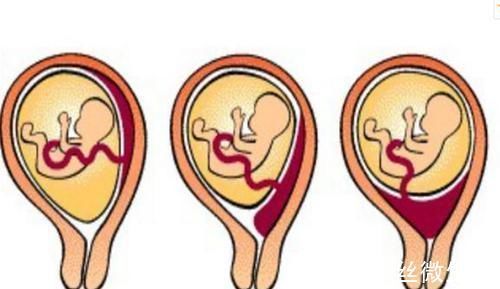 奥秘|怀孕后“肚脐凹”不易长妊娠纹,是真的吗?背后奥秘很多人不知道