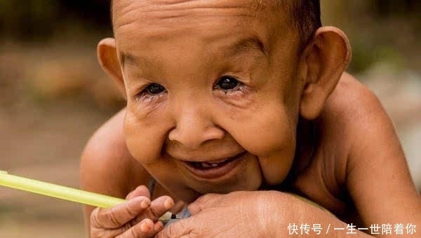 男孩|印度4岁男孩面容如90岁老翁,3个月大牙齿长全