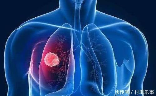 日常生活中|身体出现这4个表现,可能肺癌早期的信号,还请及时就诊检查