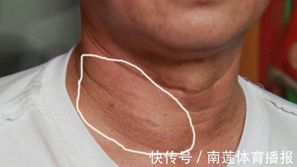 骨质增生|很多“病”并不算病，只是人老了，以下4类疾病，无需过度治疗