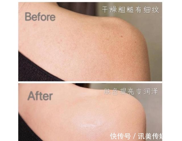 买了裙子，但是鸡皮还没解决！有啥办法缓解鸡皮肤？