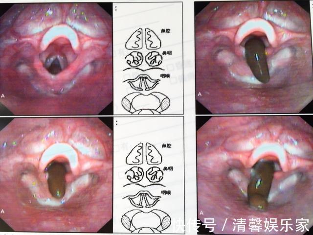 检查|4岁女孩常流鼻血,去医院检查却被送手术室,妈妈表示都怪我