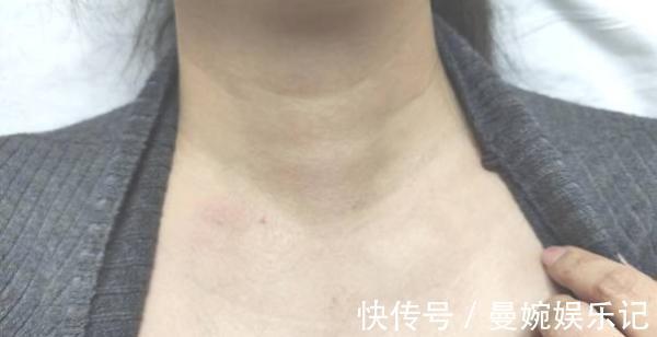 肌瘤|增生、结节、肌瘤、囊肿、肿瘤：介绍一个中成药