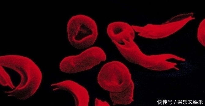 指甲上出现“竖纹”别自己瞎猜了,3个原因才是“元凶”