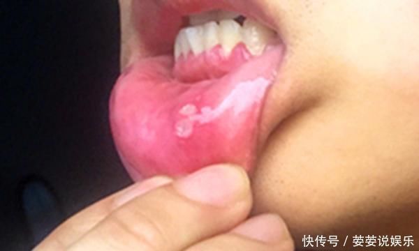 口腔癌是怎么回事医生坦言一旦出现3个信号,尽快做检查