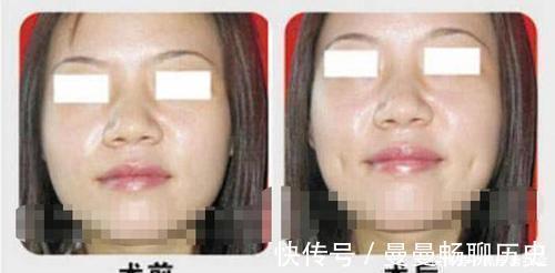 黑科技|整容界又现“黑科技”,酒窝也有人工的,网友:全身还有真的吗?