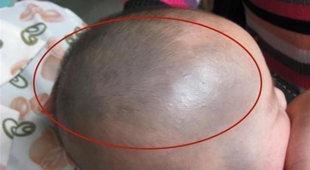 护士|发现新生儿小屁屁上有“淤青”,老公想找护士理论,最后暗暗庆幸