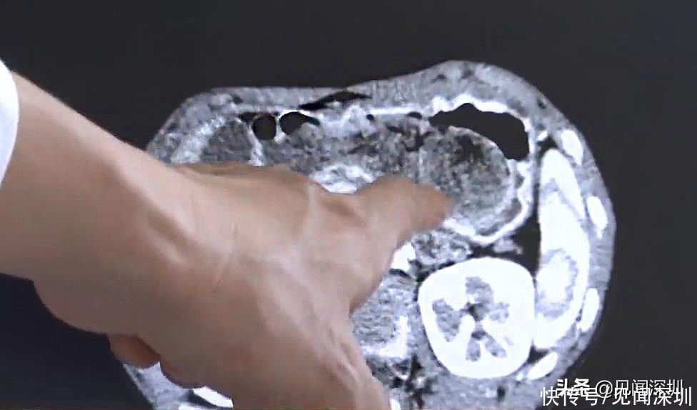 不良习惯|深圳8岁小女孩，经常腹痛食欲不振，医生发现她竟在吃这东西