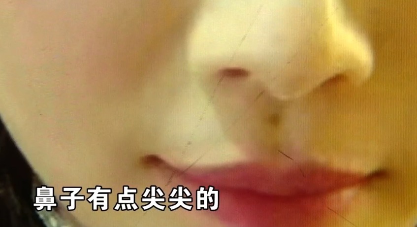 刘女士 花5万多做耳软骨隆鼻,女子术后竟不敢抬头!院方送你个双眼皮