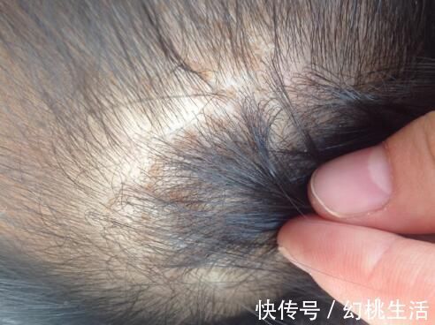 当心|头皮总是长疙瘩是怎么回事 当心是身体出现了这些问题!