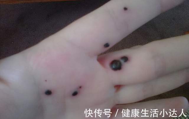 金兰菊根茶|血脂多高才算是高？身体出现5个信号，要开始降脂养血管了