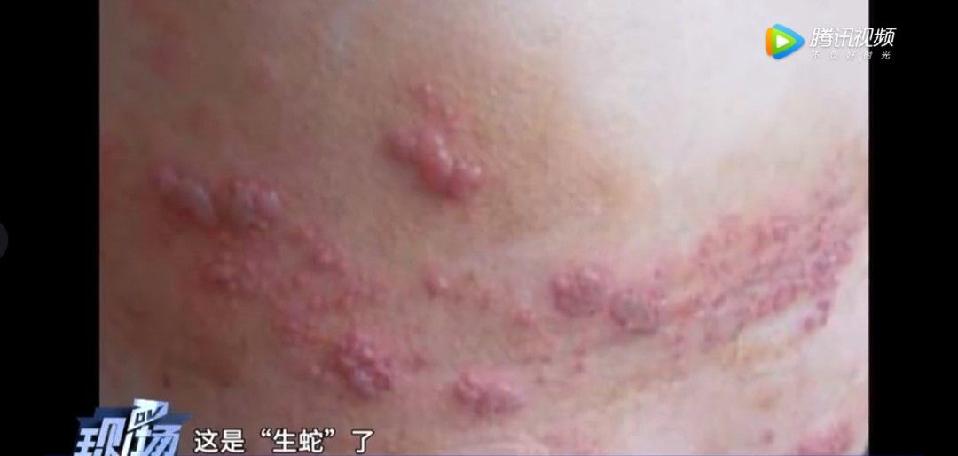 检查|广东一男子身上“生蛇”，检查结果惊出冷汗！医生紧急提醒