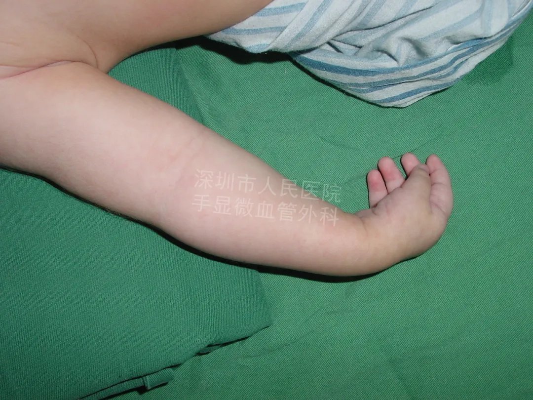 发育不良|得了这病,12岁男孩手指比香蕉还粗!7种常见的手部畸形,家长们要注意