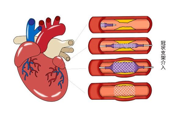 危险时刻|冠心病发作了，怎么办是好？冠心病患者到底要不要放支架？