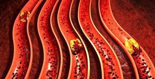 颈动脉内膜|“血管老化”的五大常见征象，您有吗？及时干预，哪些药物可选？