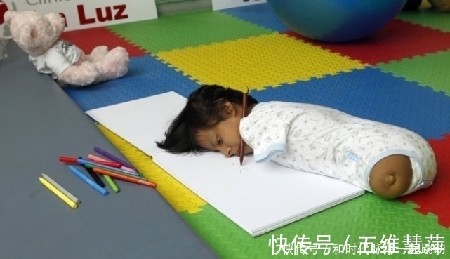 产检|孕检发现胎儿“四肢全无”,妈妈却坚持生下,如今孩子咋样了?