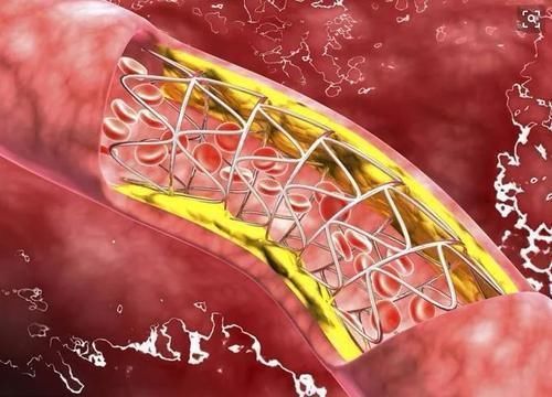 腿部|血脂高不高，”小腿“先知？医生：血脂偏高，身体或有这几个表现
