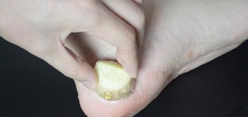  脚后跟干裂脱皮不用愁，教你一个土方法，轻松解决，省钱又实用