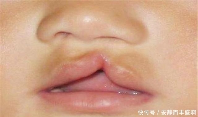 谎称|孕妈生下“兔唇”宝宝,谎称孕期食用兔肉,被医生戳穿后尴尬不已