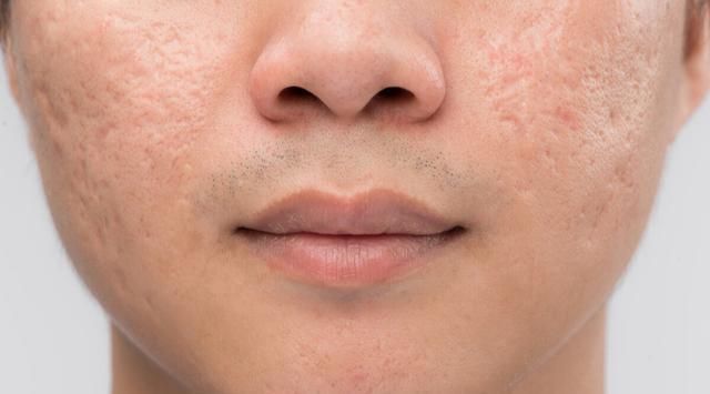 “痘坑”怎样修复,能否选择‘’无恢复期‘’的治疗项目