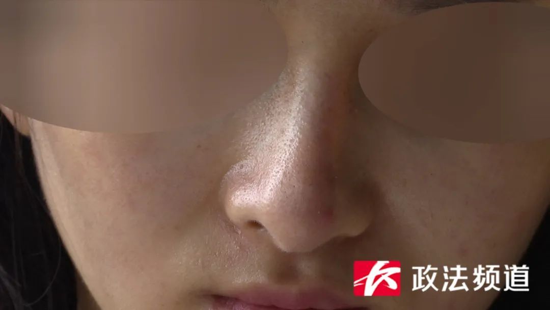 女孩整形一年后变鼻歪歪，涉事整形机构回应令她无语