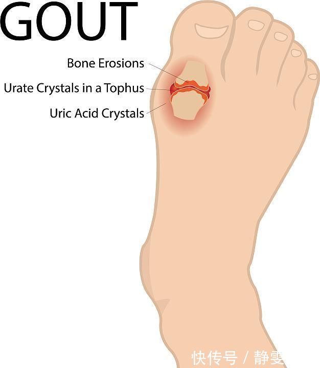 秘诀|真正降尿酸的四个秘诀，多喝水排在第二位，排在首位的你很少坚持