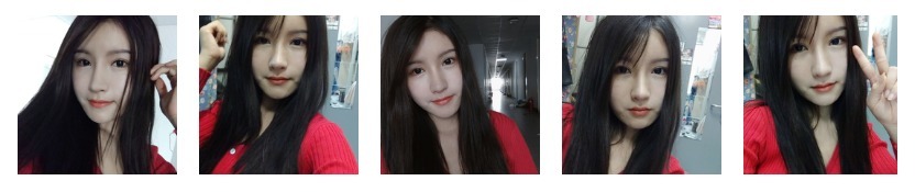 开眼角前后对比照效果图67天记录日记-焦作完美俪人案例