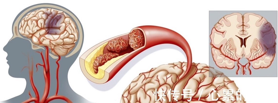 颈动脉狭窄|人到中年，不想中风，做好以下6点，让你活得更健康