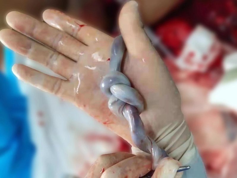 真结|惊险！胎儿脐带罕见套环式双结，顺利分娩母子平安