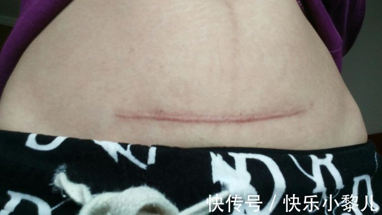 张颖|剖腹产的切口何时才能“完全愈合”?还没恢复前,这件事不要做