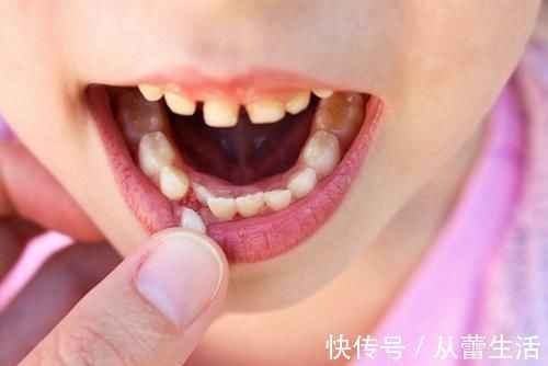 牙齿|孩子乳牙没掉,新牙就已长出?造成孩子乳牙脱落晚的原因不止一种