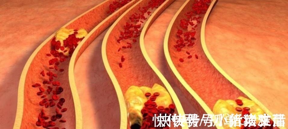 人造奶油|低密度脂蛋白升高有什么症状少碰4种食物，帮助血脂慢慢稳定