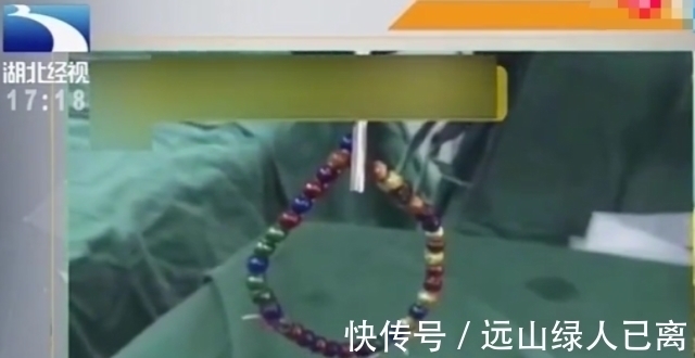 女童|女童连续高烧三天 还伴有呕吐腹胀 检查后发现肚子里“长”手链