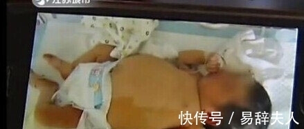 医生|【奇闻】孕妇产下“胎中胎”:刚出生8天女婴竟怀孕?