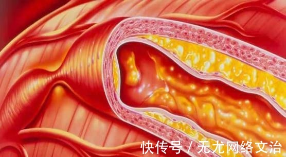 克星|高血脂“克星”公开,避免做这几件事,血管干净通畅