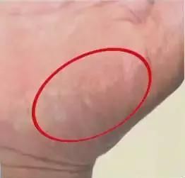 健康|觀手知健康！快速辨識高血壓、高血糖就這么看，2分鐘學會！